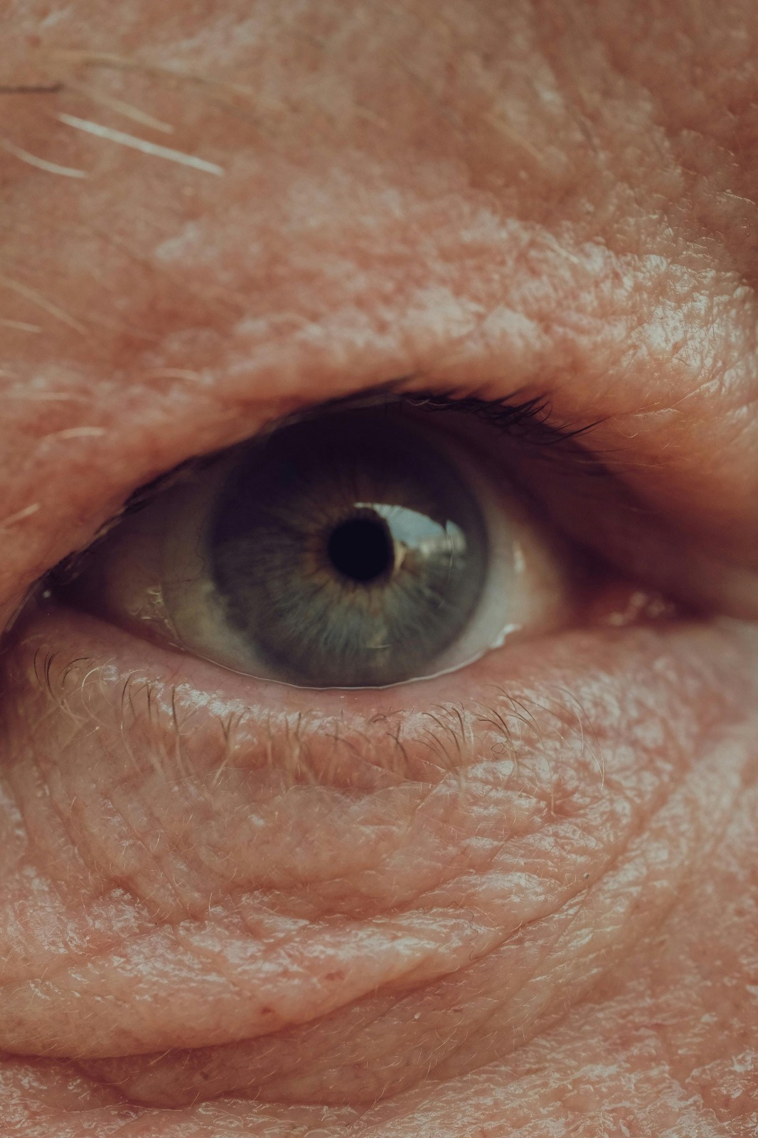 Close-up of an elderly patient's eye — representing those at risk of angle-closure glaucoma